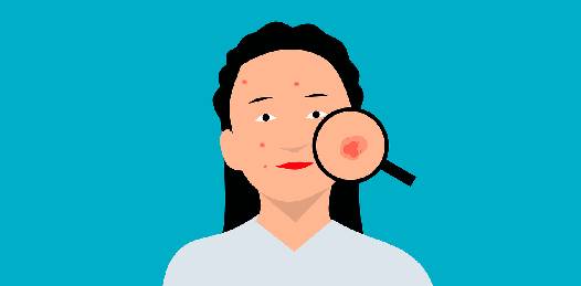How to treat hormonal acne