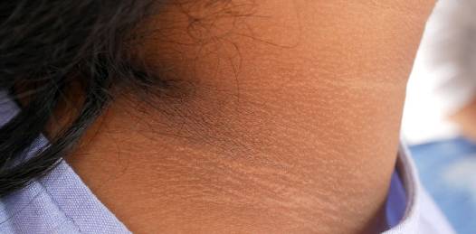 Home remedies for dark neck