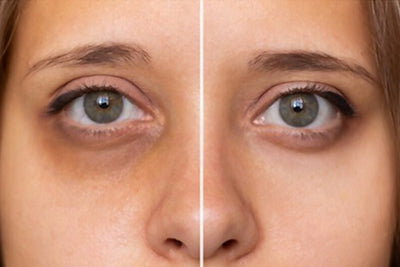 How to Reduce Dark Circles