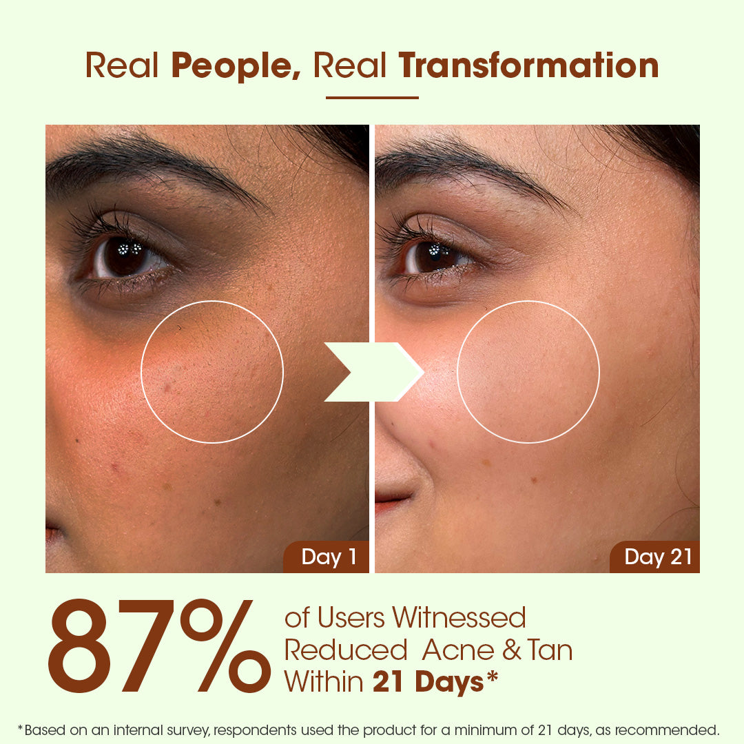 Anti Acne Day Cream