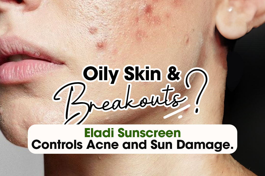 Oily Skin and Breakouts? Eladi Sunscreen Controls Acne and Sun Damage.